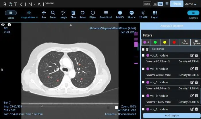 AI in Lung Cancer Detection